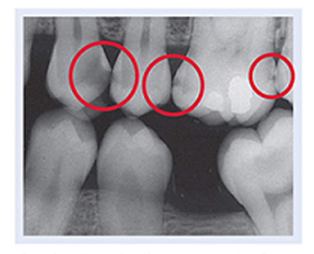 Digital XRays Metzger Dentistry