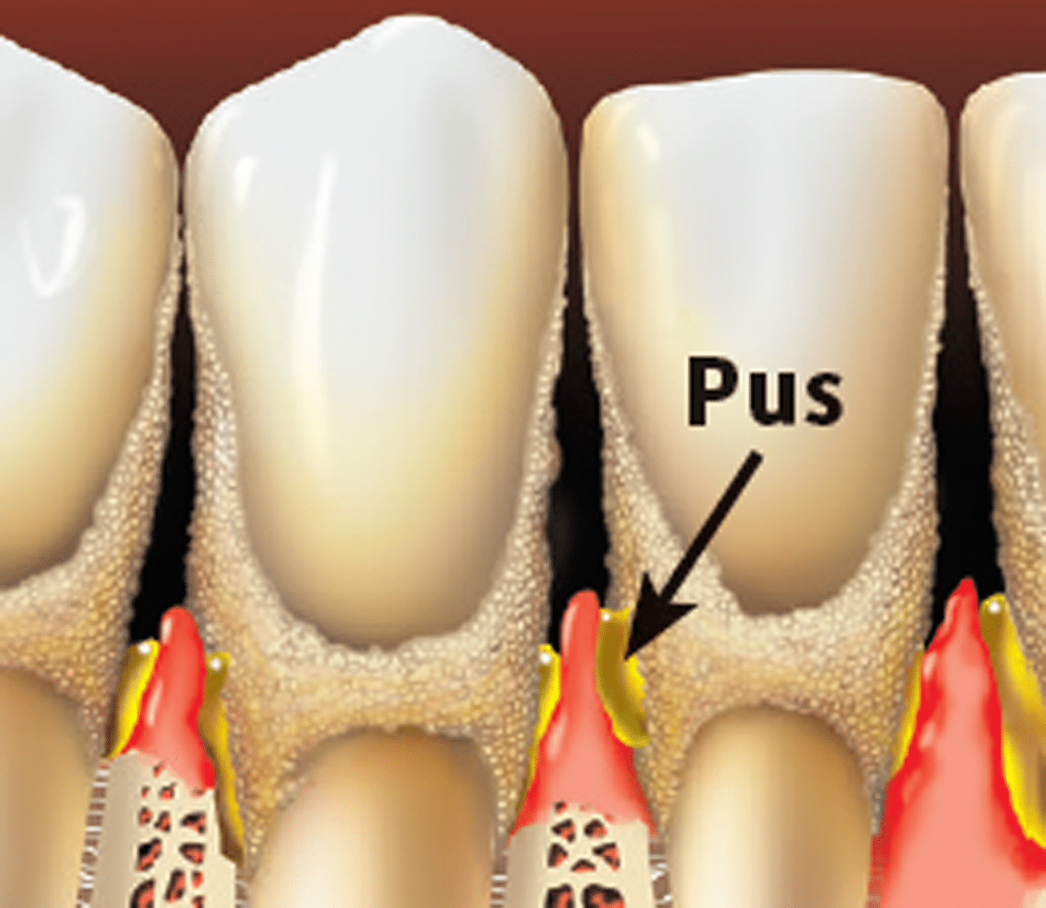 Periodontal Gum Disease Treatment Metzger Dentistry