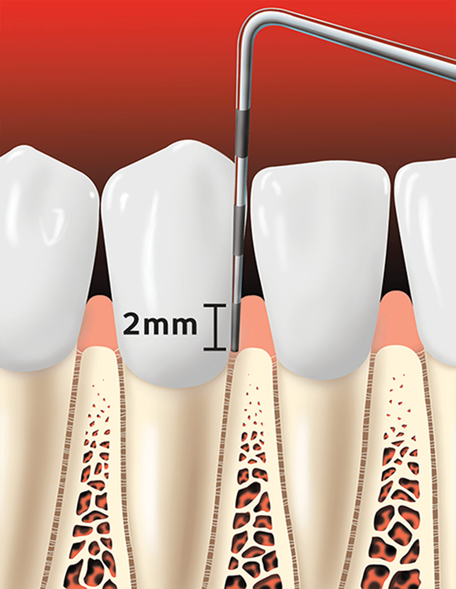 Periodontal (Gum) Disease Treatment - Metzger Dentistry