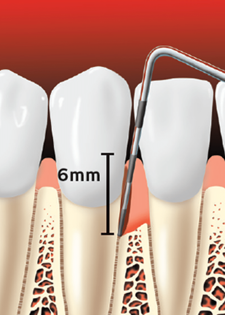 Periodontal (Gum) Disease Treatment Metzger Dentistry